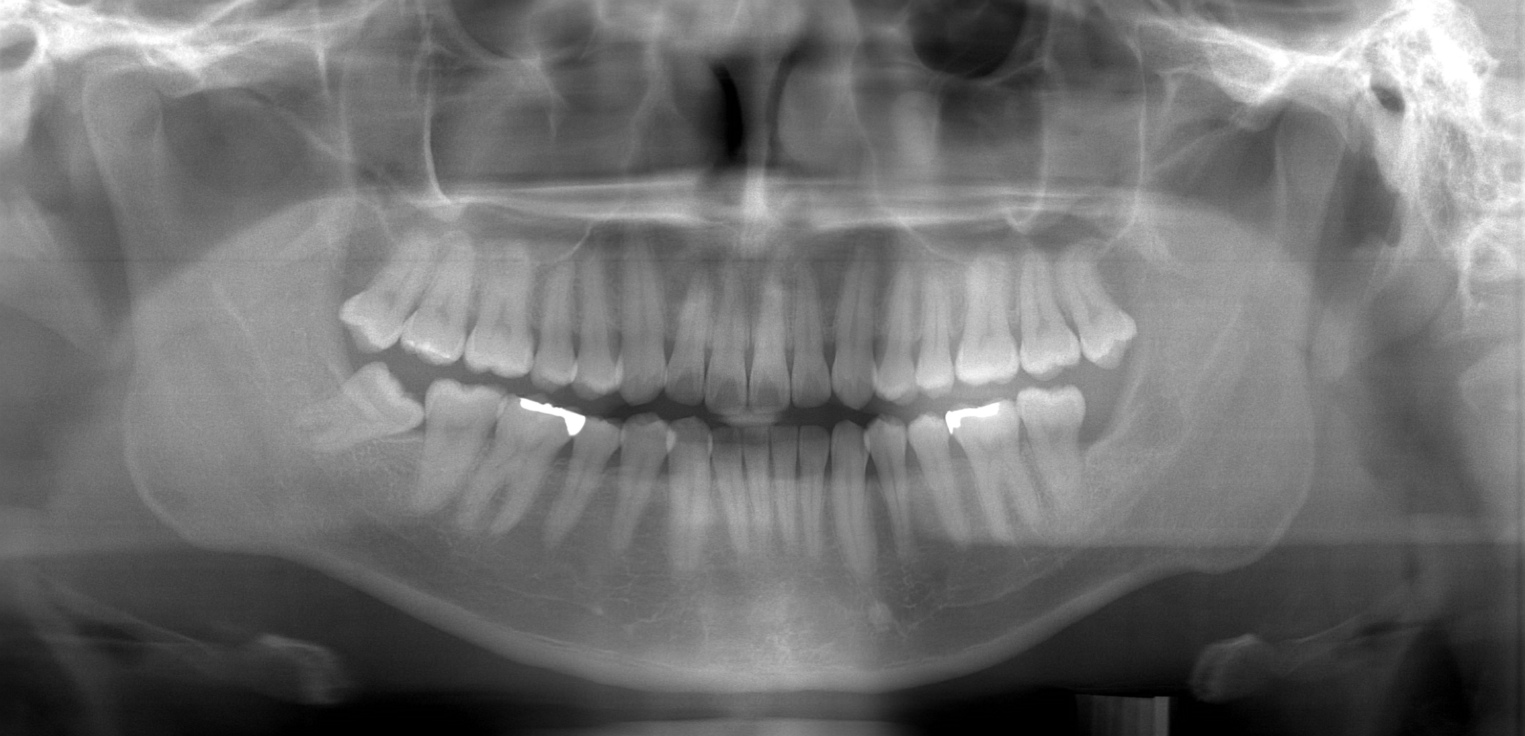 歯科パノラマX線画像のMCI分類とは？｜骨と歯の健康連携ポータル