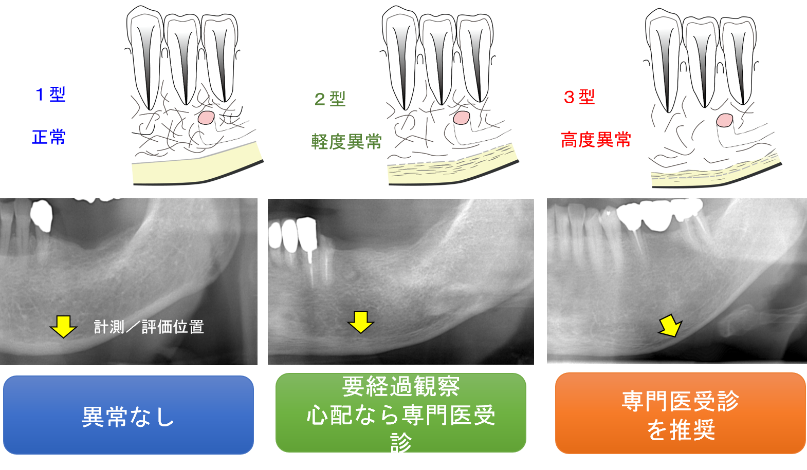 歯科パノラマＸ線画像のMCI分類とは？｜骨と歯の健康連携ポータル